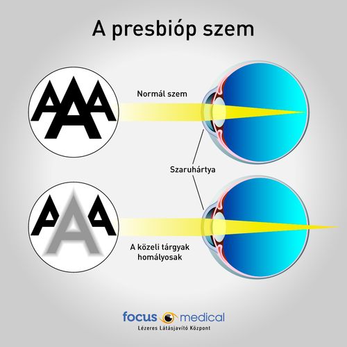 A presbióp szem