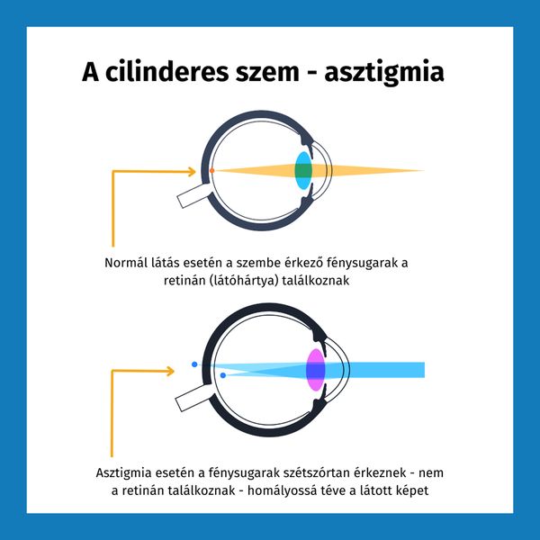 A cilinderes szem - asztigmia