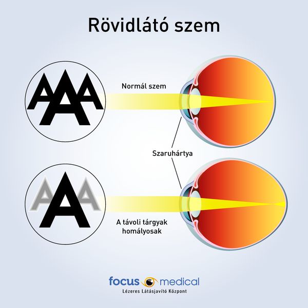 Rövidlátó szem